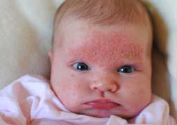 بیماری پوستی نوزاد